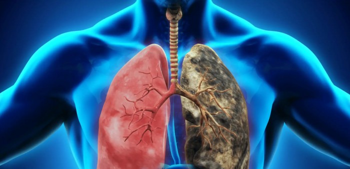 COPD progressive disease that can be fatal